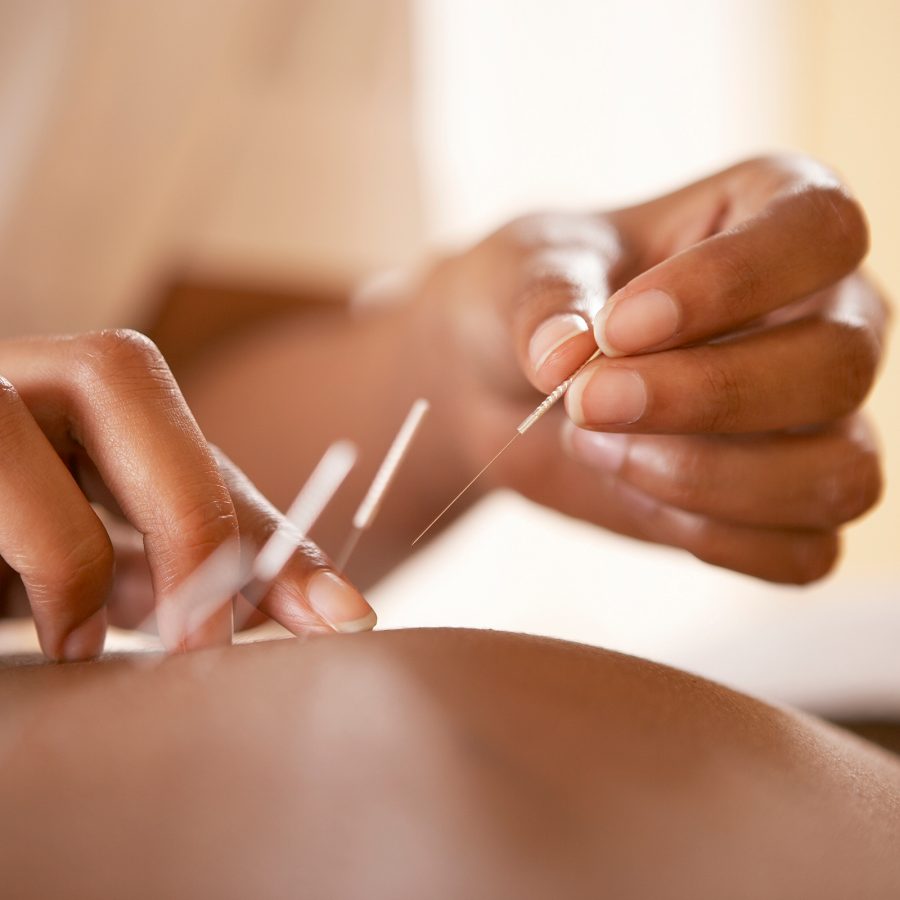 Close-up of a person receiving acupuncture treatment. 